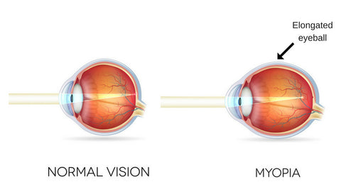 Normal eye vs myopic eye