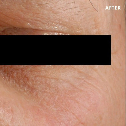 AGE-Eye-Complex-for-Dark-Circles-After-SkinCeuticals-ID-Cosmetic-Clinic