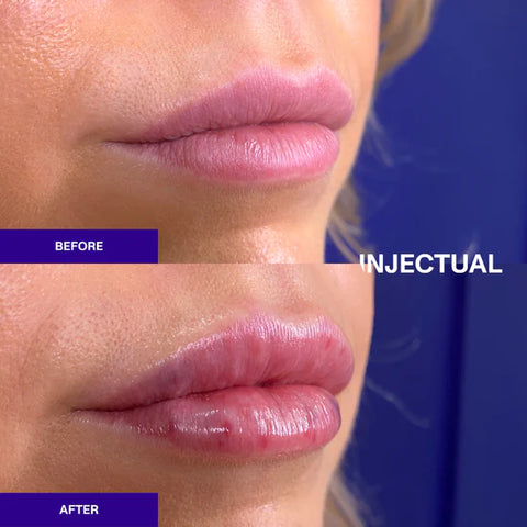 Injectual Lip Filler Before and After