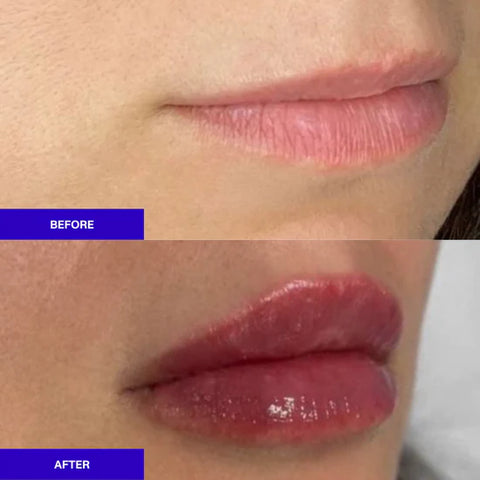 Dermal filler lips before and after