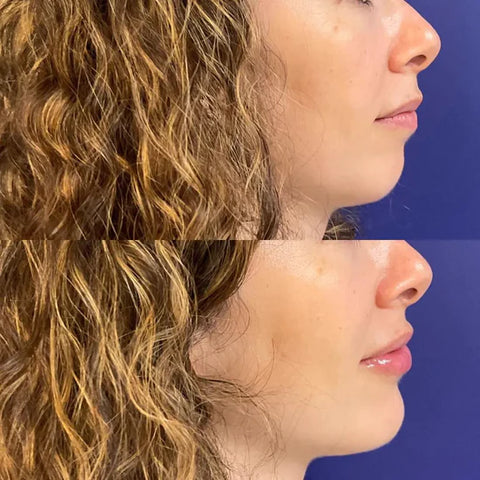 Chin Filler Before & After