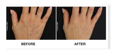 Profhilo hands before and after