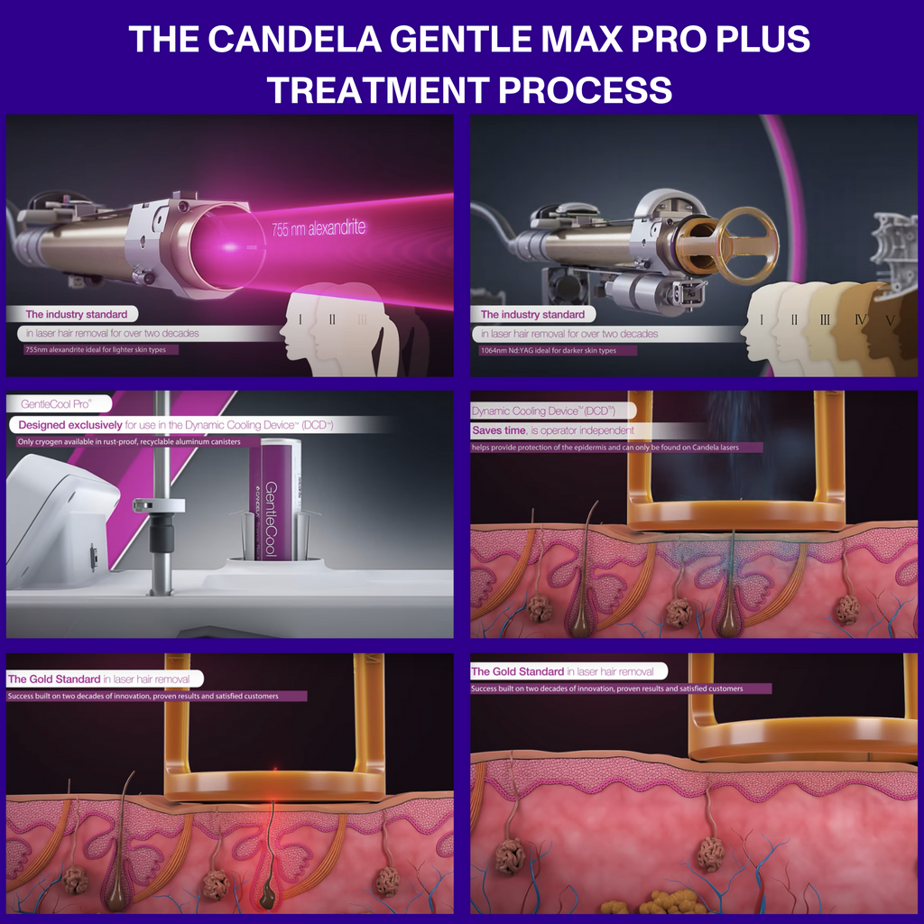 CANDELA GENTLE MAX PRO PLUS TREATMENT PROCESS