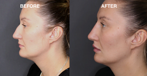 Dermal filler nose job before and after