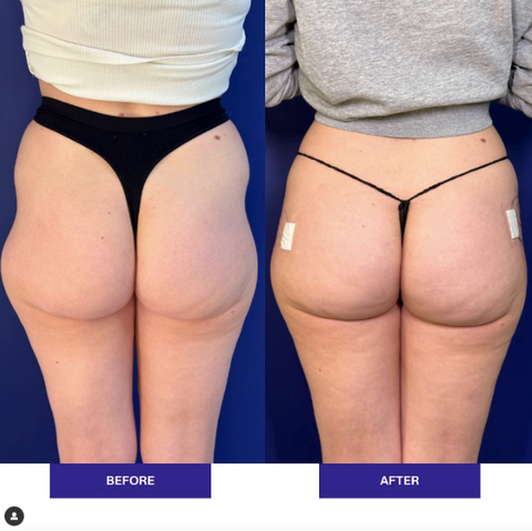 Hip Dips Before and After