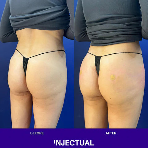 Hip-dip fillers  Eternel clinic #1 Aesthetic & dermatology clinic