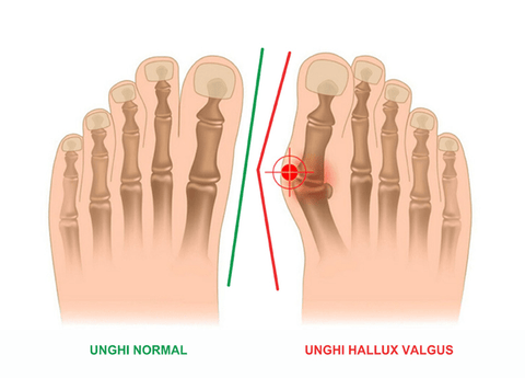 Hallux Valgus Monturi