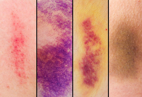 Different stages of bruising