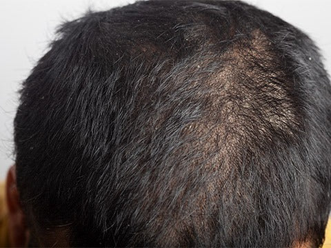 Dry and Oily Scalps Of Men Head