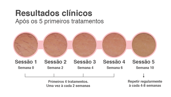 Depilador Permanente a Laser | donelebox.com