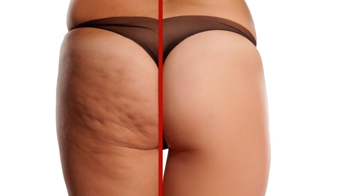 Exploring Different Ways to Get Rid of Cellulite on The Thighs