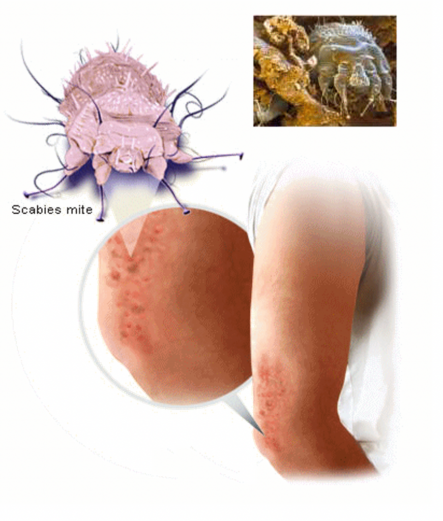 Scabies – Skabi-Rid