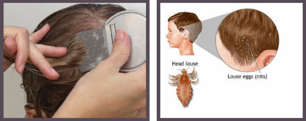 Head and Body Lice – Skabi-Rid