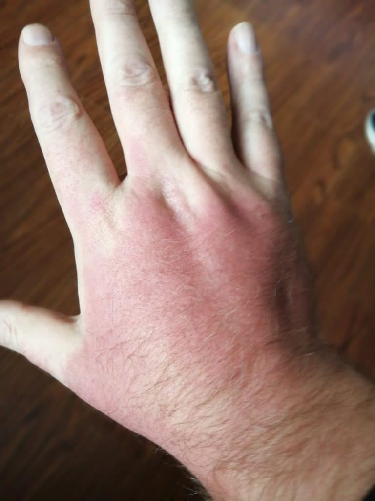Swallen Hand due to heigh altitude and sun
