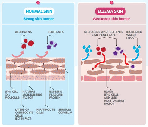 Normal vs. Eczema Skin Diagram