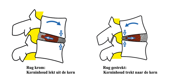 Rug krom versus rug gestrekt