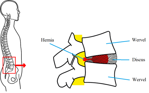 hernia is het gevolg van een scheur in een tussenwervelschijf