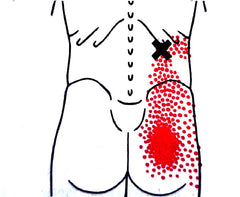 Rugpijn Triggerpoints 2