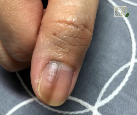 Nail Discoloration - Green, Blue, Black, White or Yellow, Why ?