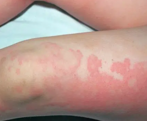 child with hives 