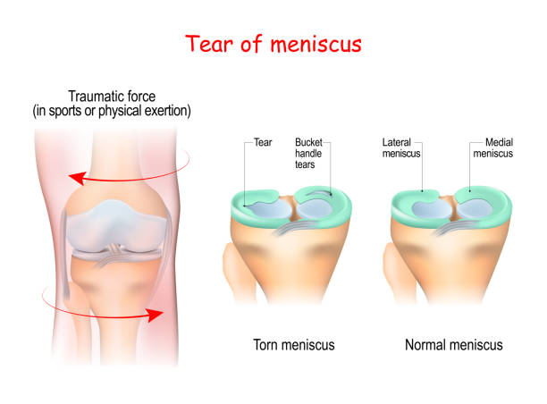 What is the Meniscus