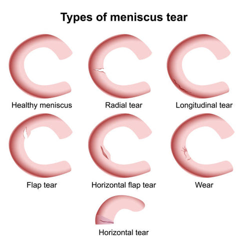 Type of Meniscus Tear