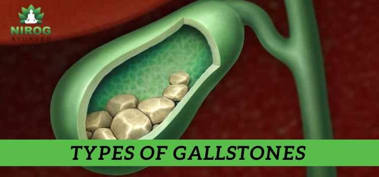 In this image, A diagram is showing gallstones in gallbladder.