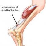 Problemas de los pies Imagen de tendinitis de Aquiles