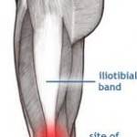 IT-Band-Syndrom