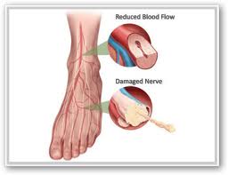 Nerve damage and low blood flow