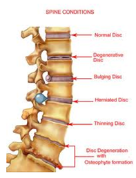 Spinal conditions
