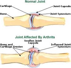 Arthritis joint and normal joint
