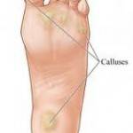 Calluses