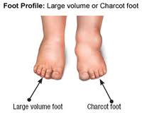 Edema Charcot Foot