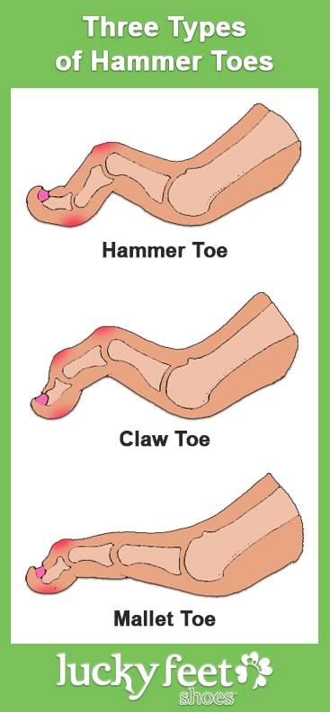 Best Shoes for Hammer Toes