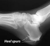 heel spur x-ray