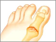 Arthritis in toe joint