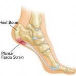 Plantarfasziitis