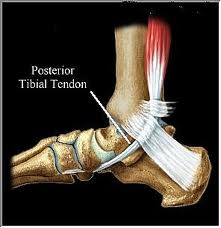 post tibial tendon-Fallen Arches