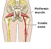 piriformis_sciatic_pic