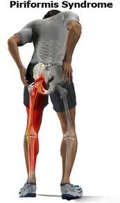 Piriformis-Syndrom