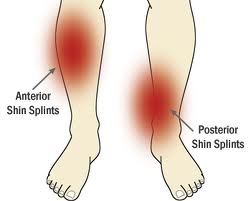 shin splints