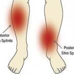 Shin Splints