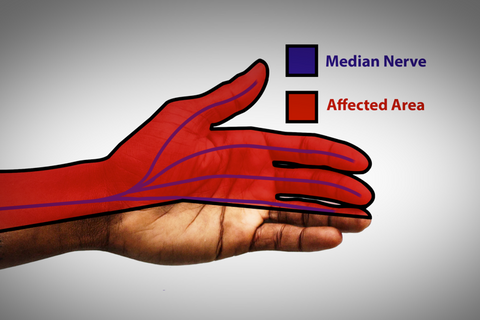 Median Nerve and Affected area - edited by Handexer Hand Dynamometer