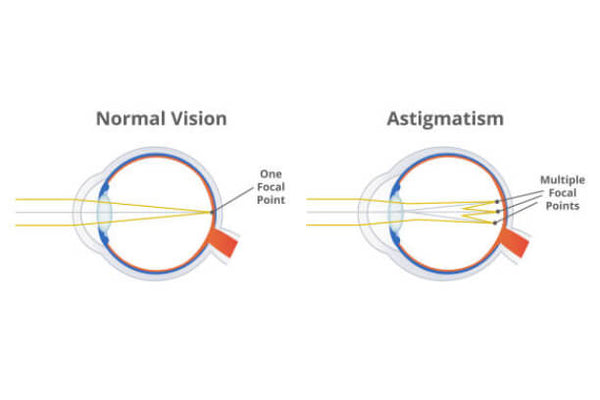 how astigmatism occurs