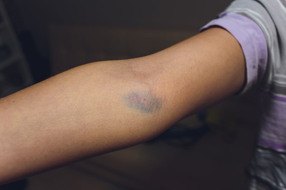 An example of a blown vein on an arm.