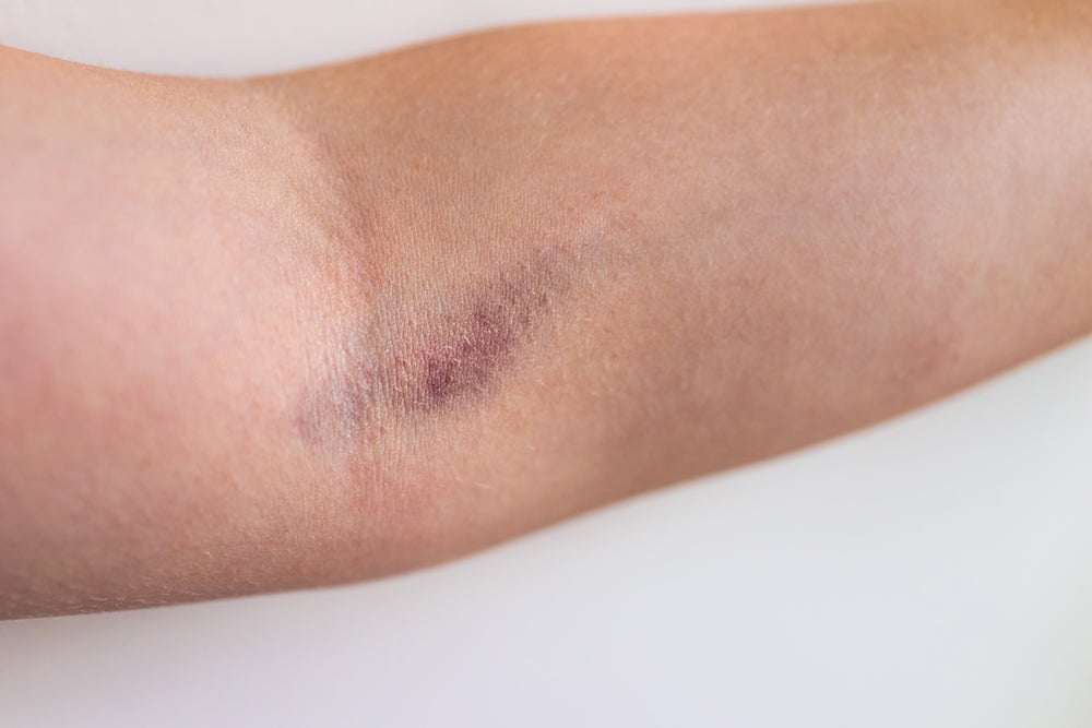 Example of a bruised vein on an arm.