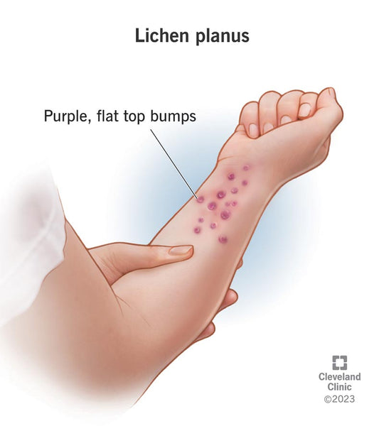 Lichen planus: Kaj je to, vzroki, vrste in zdravljenje
