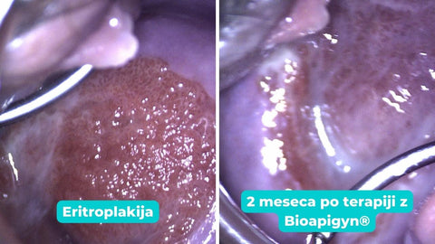 Uspešnost zdravljenja vaginalne eritroplakije z mazilom Bioapigyn®