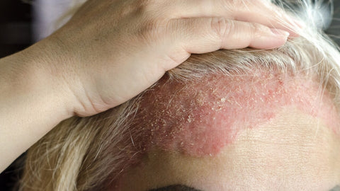glavni simptomi luskavice, luskasta koža, luske po koži